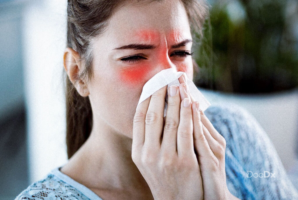 Sinusitis